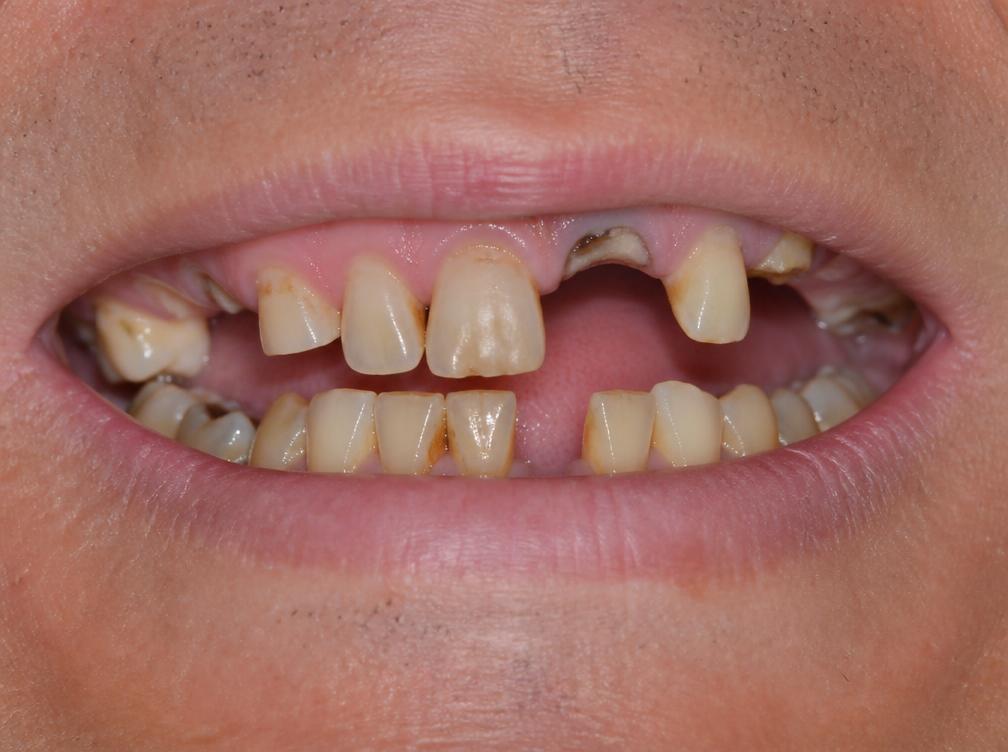 Sorriso antes do tratamento com prótese dentária