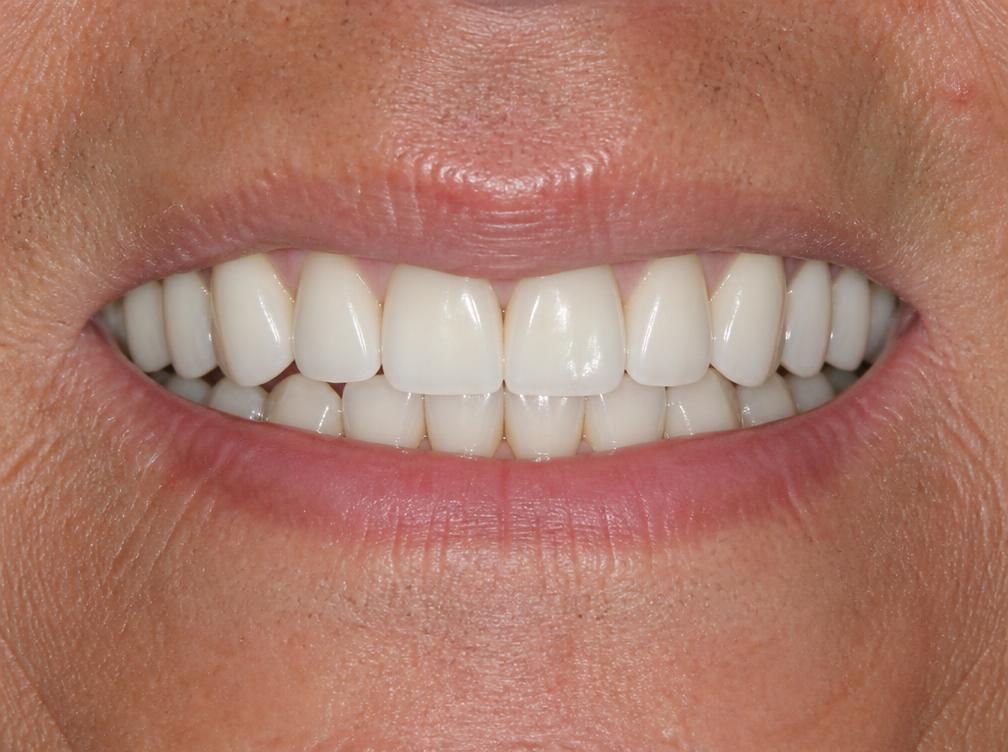 Sorriso depois do tratamento com prótese dentária